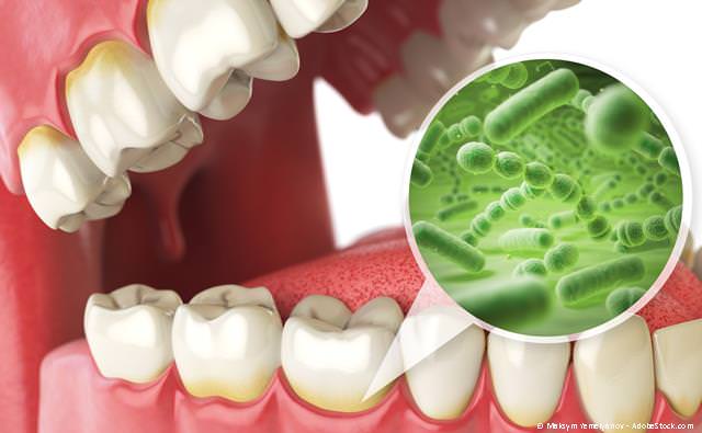 Parodontitis-Behandlung bei Zahnfleischentzündungen und Zahnlockerung