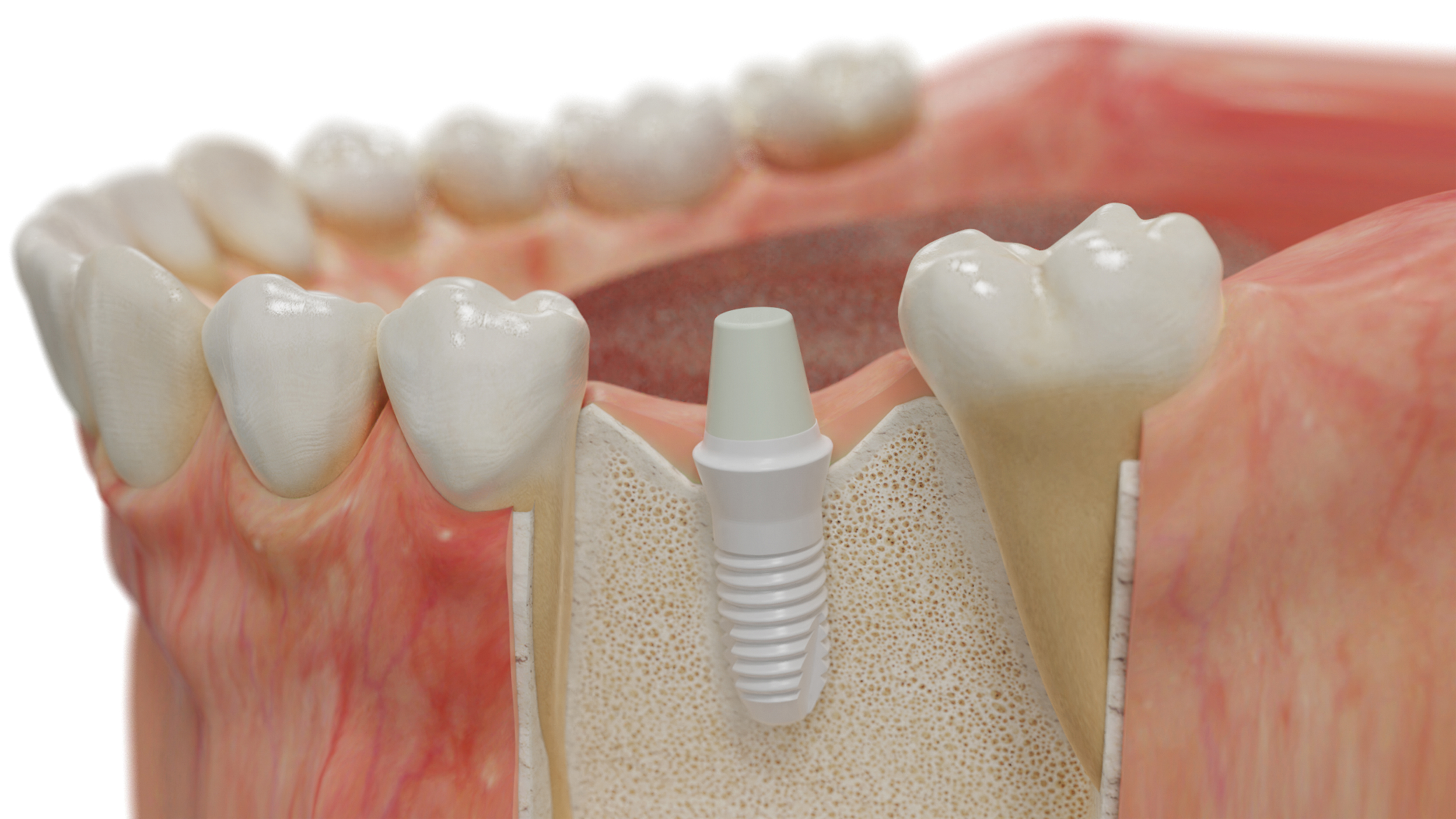 Keramik-Implantat: Wenn kein Metall im Mund möglich ist