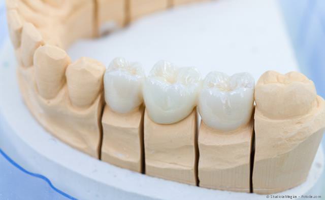 Hochwertiger Zahnersatz: Zahnkronen, Zahnbrücken und Zahnprothesen